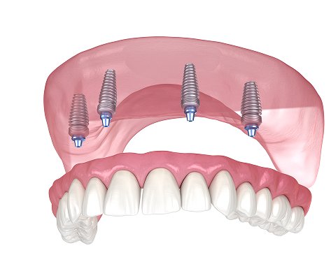implant images